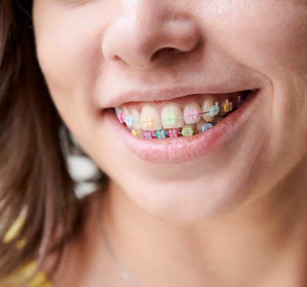 Close up of female patient smiling and showing brackets with multicolored rubber bands. Woman demonstrating wired braces with colorful dental rings. Concept of dentistry, orthodontics and stomatology.